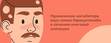 Применение ингибитора янус-киназ барицитиниба в лечении очаговой алопеции