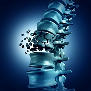 Скрининг на остеопороз для профилактики переломов. Клинические рекомендации 