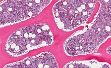 Гемофагоцитарный лимфогистиоцитоз на фоне терапии рассеянного склероза алемтузумабом