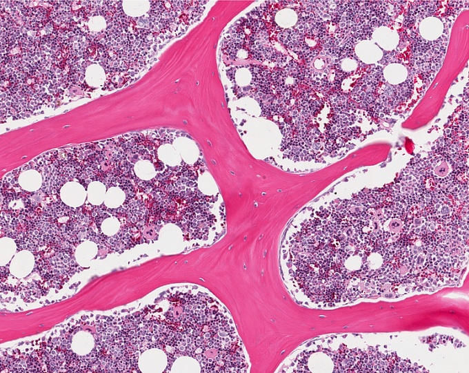 Гемофагоцитарный лимфогистиоцитоз на фоне терапии рассеянного склероза алемтузумабом