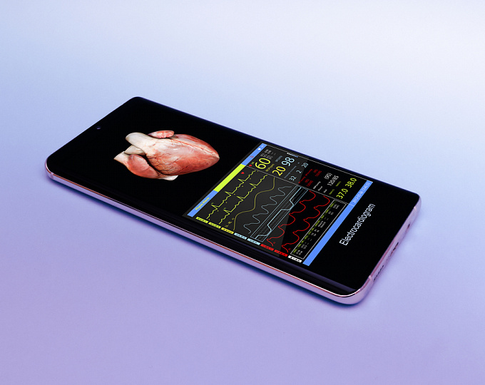Можно ли доверять диагностику фибрилляции предсердий мобильным приложениям?