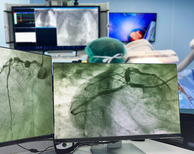 Катетерная аблация фибрилляции предсердий при амилоидозе сердца