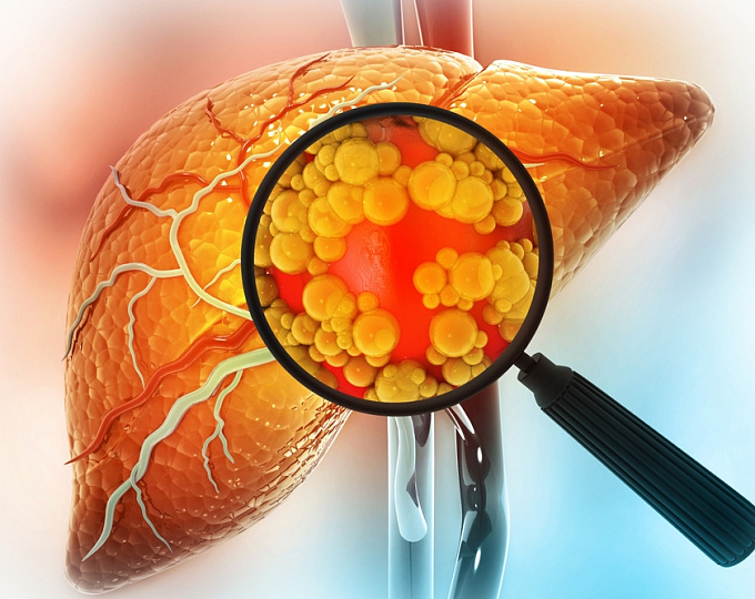 Как влияет алкоголь на прогрессию метаболически ассоциированного стеатоза?