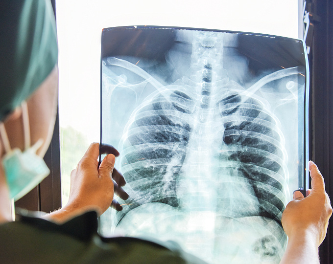 Неоадъювант синтилимаб при химиотерапии операбельного немелкоклеточного рака легкого IIIA стадии.