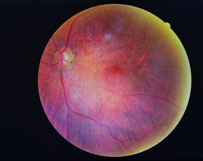Недостаточность хориокапиллярного кровотока и риск развития диабетической ретинопатии