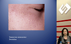 Дерматозы лица: клинические черты, значение биоценоза кожи, методы терапевтической коррекции