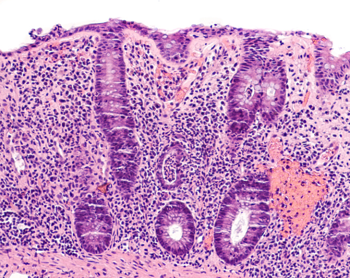 Зависит ли риск переломов от активности воспалительного заболевания кишечника?