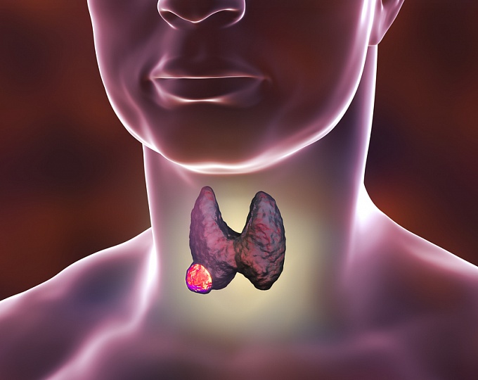 Селуметиниб не улучшает частоту ремиссии у пациентов с раком щитовидной железы 