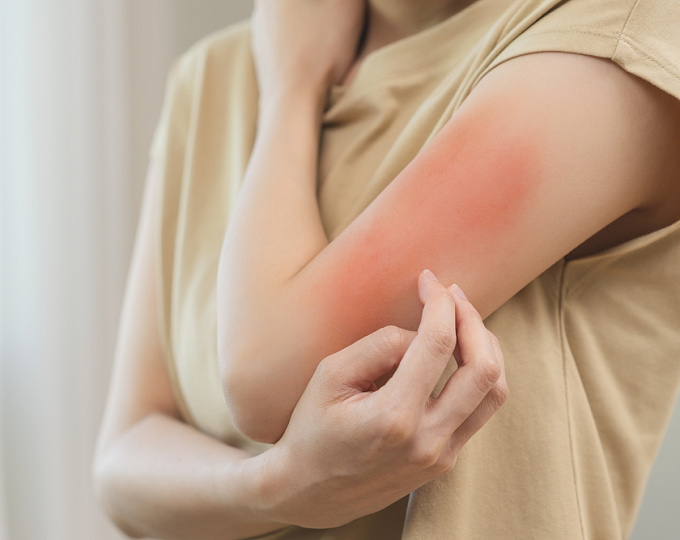 Риск развития псориаза на фоне дупилумаба у пациентов с атопическим дерматитом