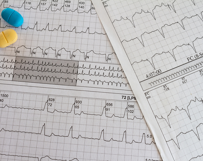 Сахароснижающие препараты и риск желудочковых нарушений ритма сердца