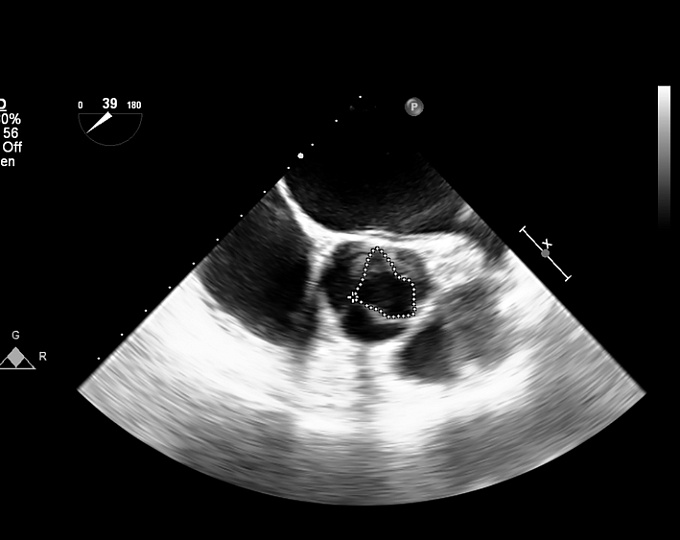 Существует ли связь между нарушениями сна и риском аортального стеноза?
