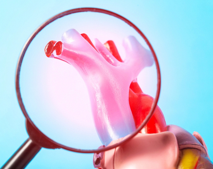 Липопротеин(а) и объем атеросклеротических бляшек