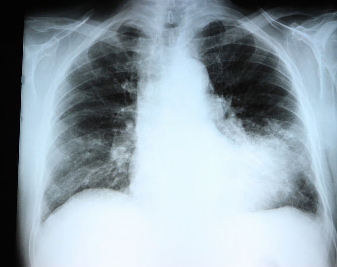 Простые клинические признаки, помогающие заподозрить пневмонию