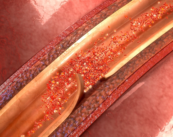 Риск инсульта у пациентов с диссекцией аорты