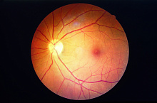 Роль микронутриентов в развитии диабетической ретинопатии
