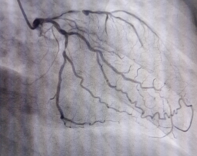 Антитромботическая терапия при диссекции шейных артерий