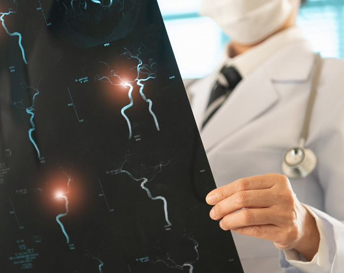 Эндоваскулярная тромбэктомия и когнитивные исходы пациентов с острым ишемическим инсультом