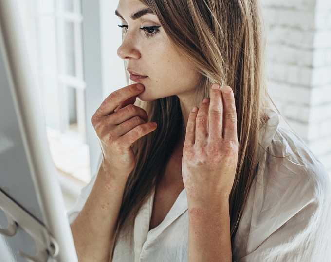 Риск преждевременных родов у женщин с псориатическим артритом