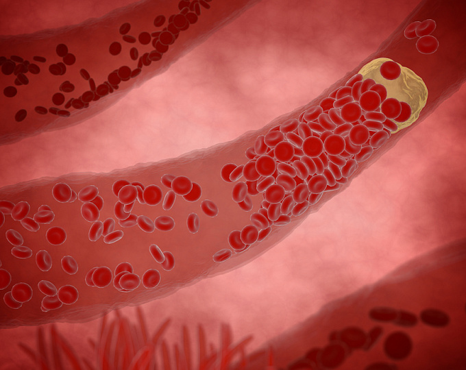Распространенность субклинического гигантоклеточного артериита у пациентов с ревматической полимиалгией