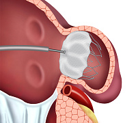 Закрытие ушка левого предсердия у пациентов с фибрилляцией предсердий
