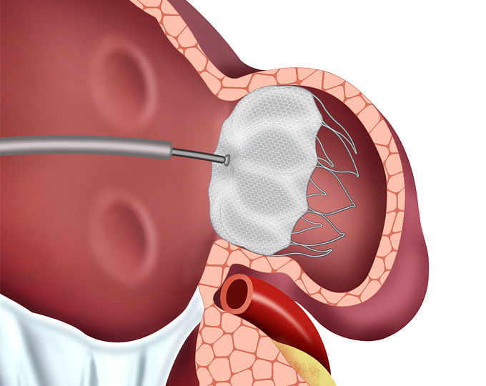 Закрытие ушка левого предсердия у пациентов с фибрилляцией предсердий
