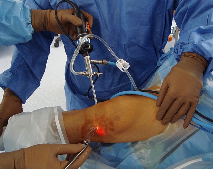 Профилактика тромбозов у пациентов, перенесших артроскопию коленного сустава