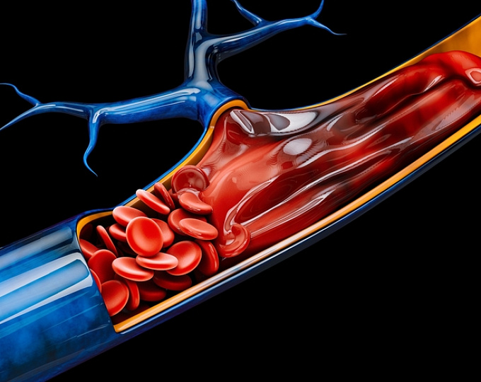 Оценка половых различий и исходов у пациентов, перенесших криобаллонную изоляцию легочных вен при мерцательной аритмии