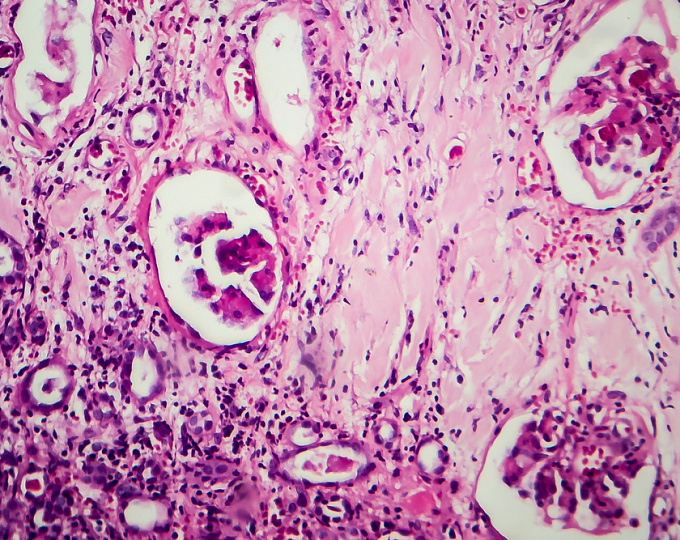 Протеинурия не определяет исходы волчаночного нефрита