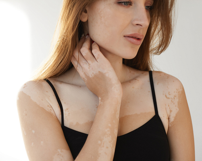 Психическое здоровье пациентов с дерматологическими заболеваниями 