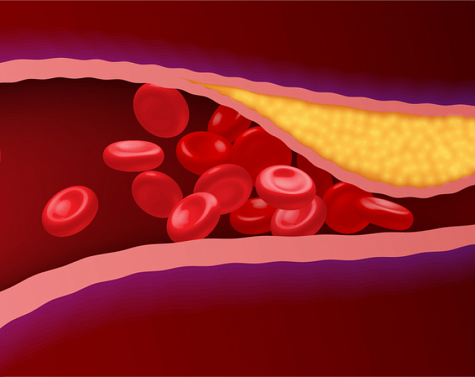 Эффективность нового орального ингибитора PCSK9 энлицитида