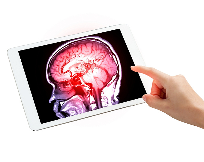 Влияют ли травмы головного мозга на риск развития инсульта?