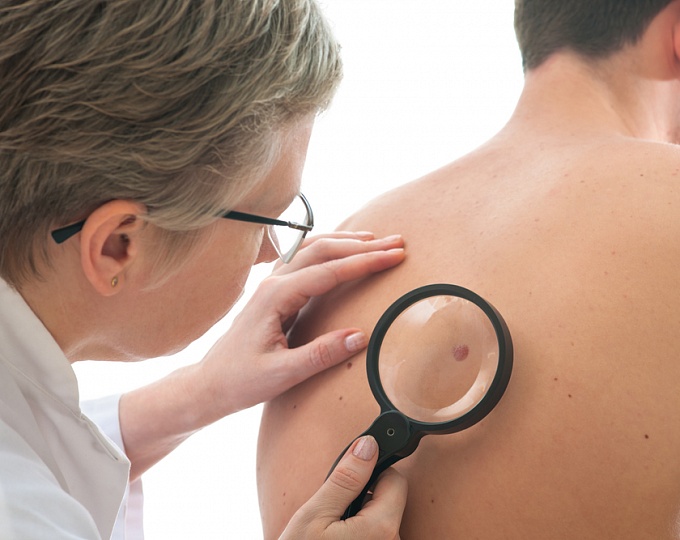 Европейское Медицинское Агентство проверит связь между гидрохлортиазидом и раком кожи 