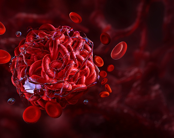 Функциональные исходы внутривенного тромболизиса у пациентов с малым инсультом