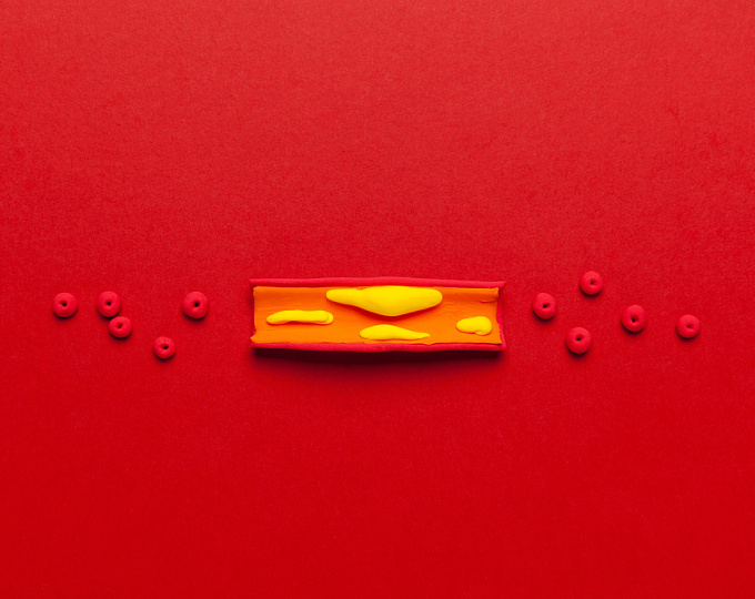 Артериальное давление в подростковом возрасте и атеросклероз в среднем возрасте: есть ли связь?