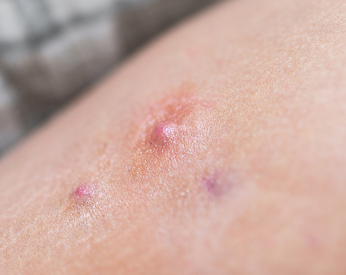 Онкологический риск у пациентов с суппуративным гидраденитом