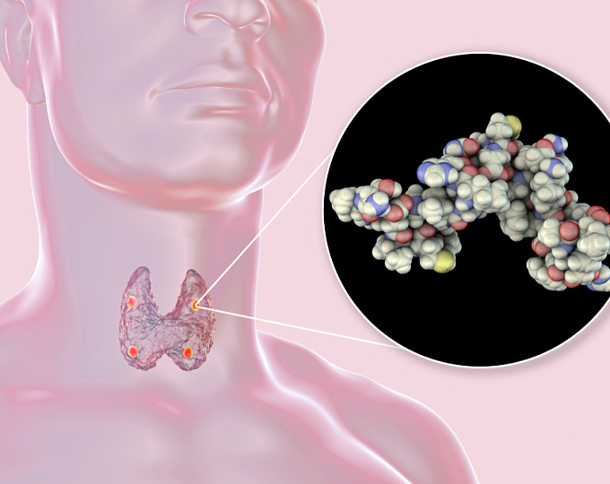 Можно ли назвать паратиреоидэктомию панацеей нефролитиаза при первичном гиперпаратиреозе?