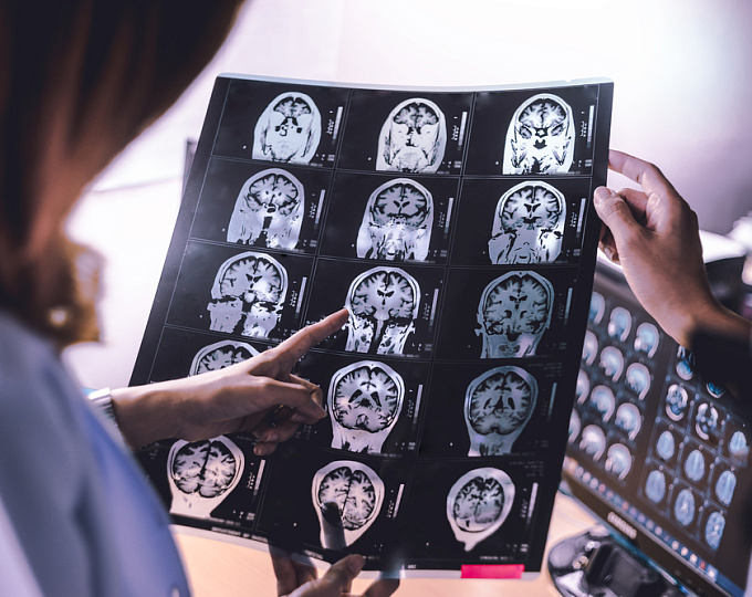 Риск инсульта у женщин с фибрилляцией предсердий