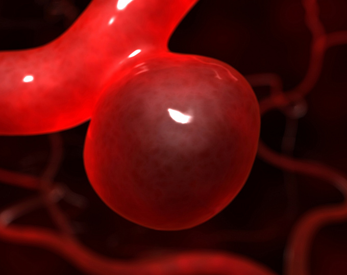 Фторхинолоны и риск формирования аневризмы аорты у взрослых 