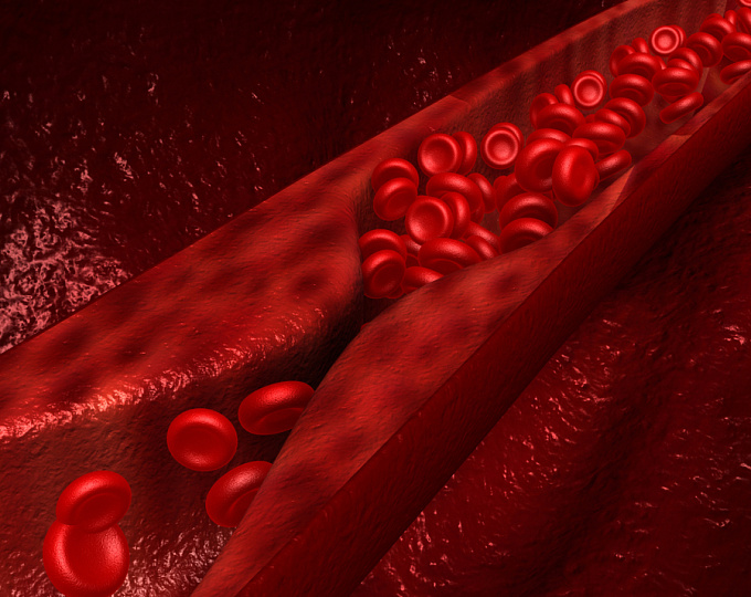 Как бляшки в сонных артериях влияют на риск инсульта у пациентов с ФП?