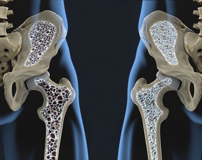 Как вести пациентов с остеопорозом после прекращения терапии деносумабом?