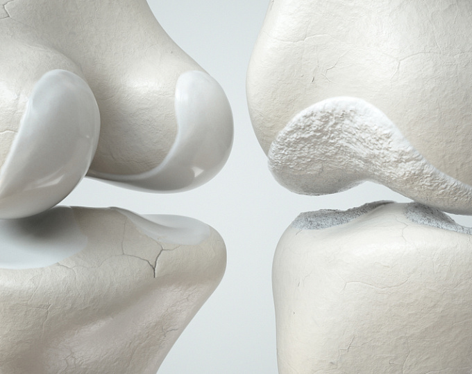 Снижение веса как верный метод профилактики остеоартрита