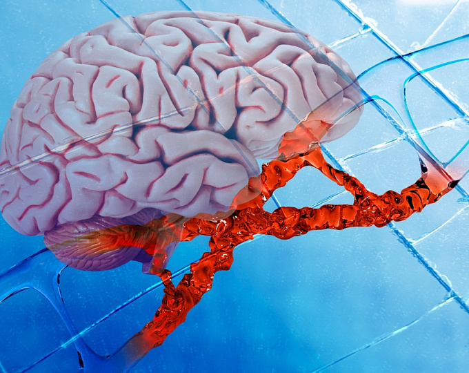 Сравнение апиксабана и АСК у онкологических пациентов с криптогенным инсультом