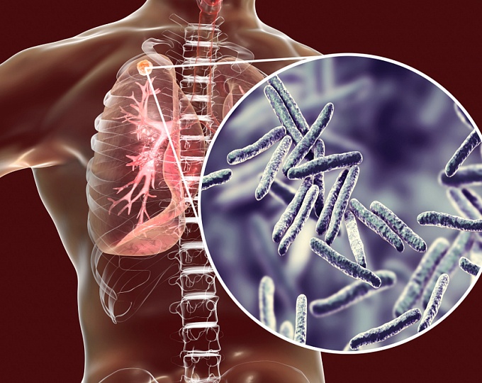 Таинственный туберкулез, существует ли естественный иммунитет? 