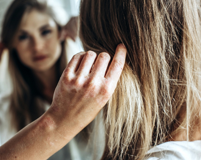 Катетерная аблация фибрилляции предсредий у пациентов с псориазом