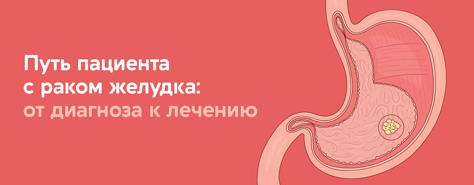 Путь пациента с раком желудка: от диагноза к лечению