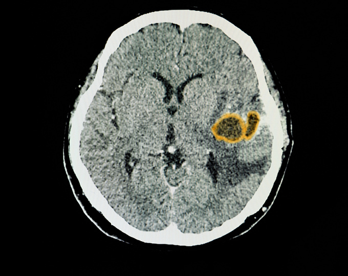 Особенности эпилепсии у пациентов с первичной лиифомой центральной нервной системы