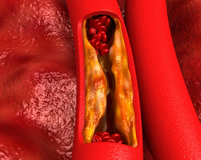 Вклад повышенного уровня ХС-ЛПНП в сердечно-сосудистый риск в отсутствии кальцификации коронарных артерий