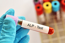 Вклад нормализации уровня щелочной фосфатазы в выживаемость без осложнений при первичном билиарном холангите