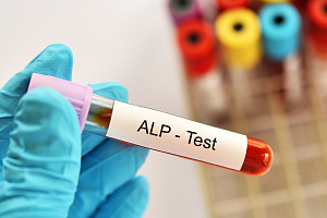 Вклад нормализации уровня щелочной фосфатазы в выживаемость без осложнений при первичном билиарном холангите