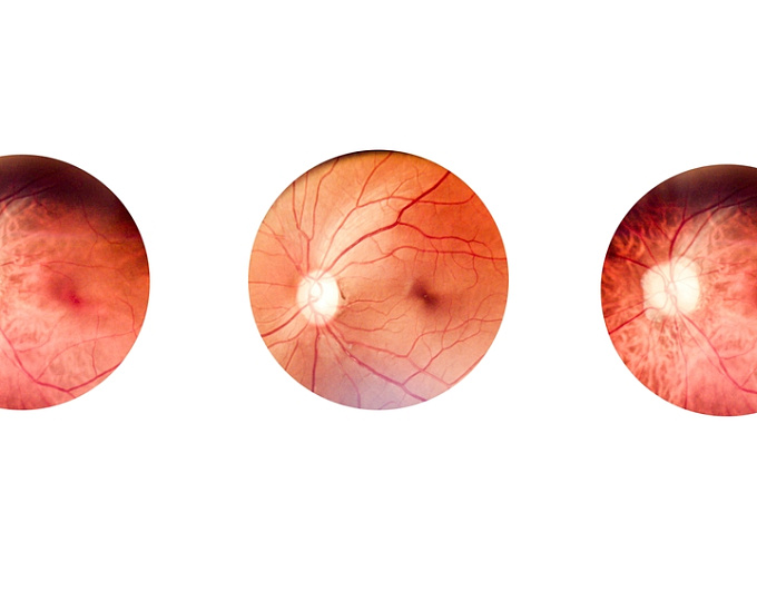 Вклад диабетической ретинопатии в развитие деменции